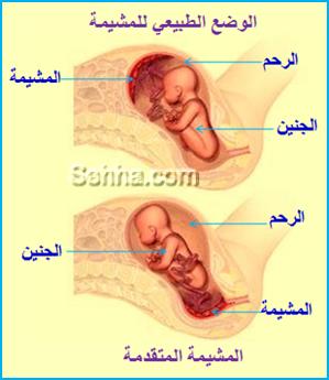 اسباب انفصال المشيمة اثناء الحمل